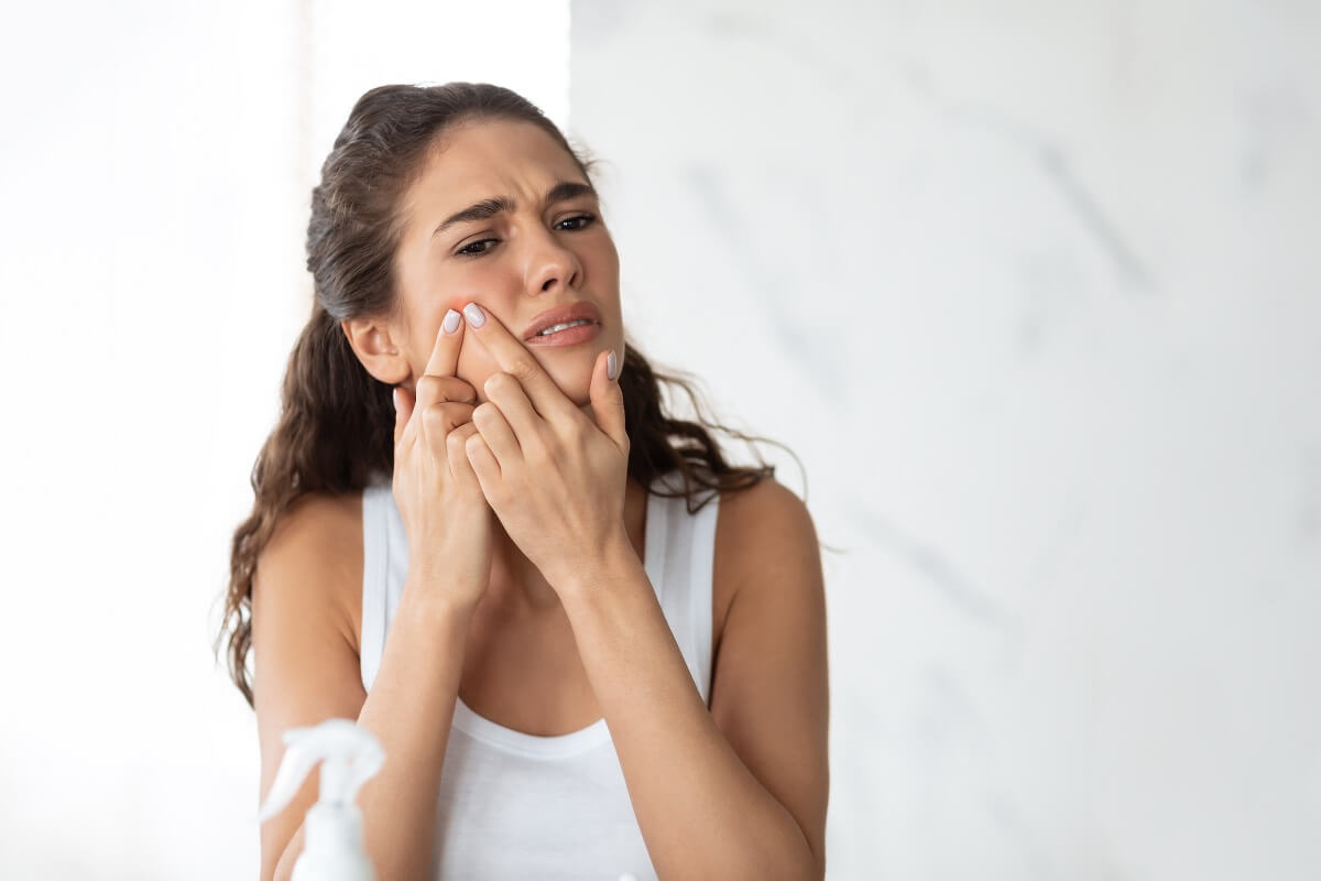 5 coisas que você precisa saber sobre acne hormonal