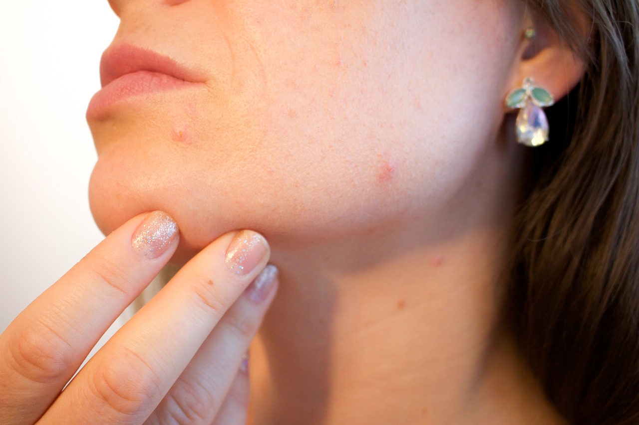 O que fazer para evitar acne na vida adulta